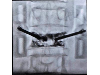 Giảm đau lưng nhanh chóng với phương pháp bơm xi măng sinh học – thực hiện trong ngày