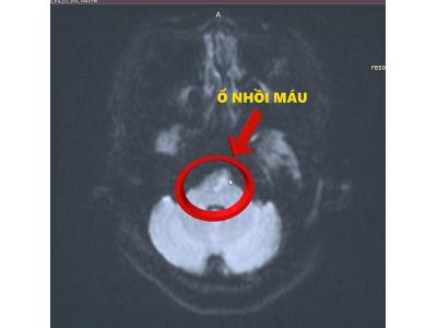 Giờ vàng cứu não – BVĐK Tâm Minh Đức