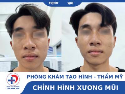 Phẫu thuật chỉnh hình mũi sau tai nạn – Dịch vụ tại Bệnh viện Tâm Minh Đức Cần Thơ