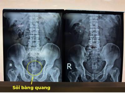 Phẫu thuật nội soi tán sỏi bàng quang kích thước lớn