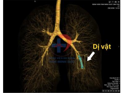 Que tránh thai di chuyển bất thường vào phổi – Ca bệnh hiếm gặp tại Bệnh viện Tâm Minh Đức