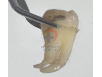 Răng khôn – tưởng dễ mà không hề dễ