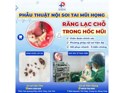 RĂNG MỌC Ở HỐC MŨI