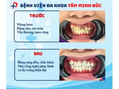 Trám răng thẩm mỹ – Không đau, tự nhiên như răng thật